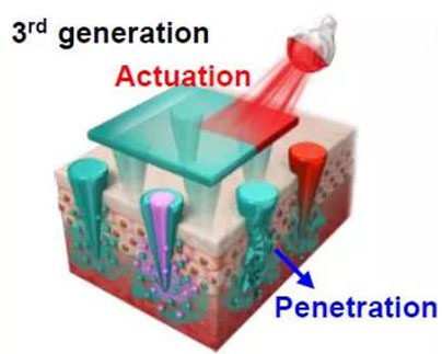 第三代：通过微针介导的皮肤层破坏和微针伴随的各种功能增强药物转运.jpg