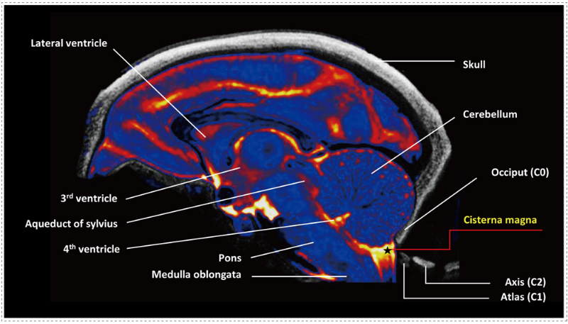 猴脑中小脑延髓池-(CM)-的定位示意图.jpg